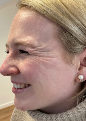 Before - Crow's Feet Treatment