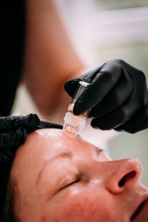 Skin Boosters