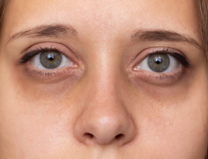 Dark Circles Under the Eyes